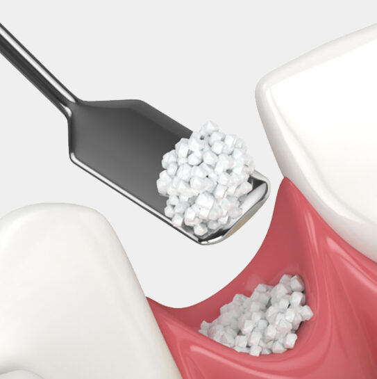 Dental Bonding