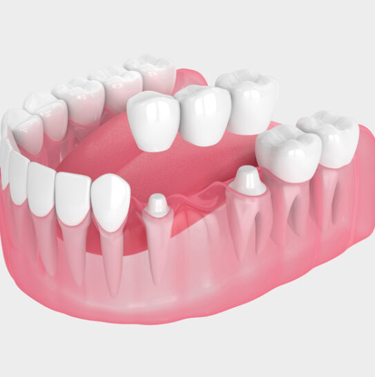 Dental Bridges