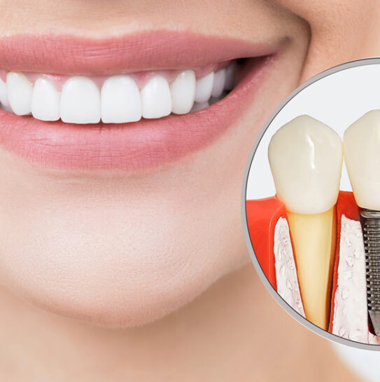 Dental Implants Restorations