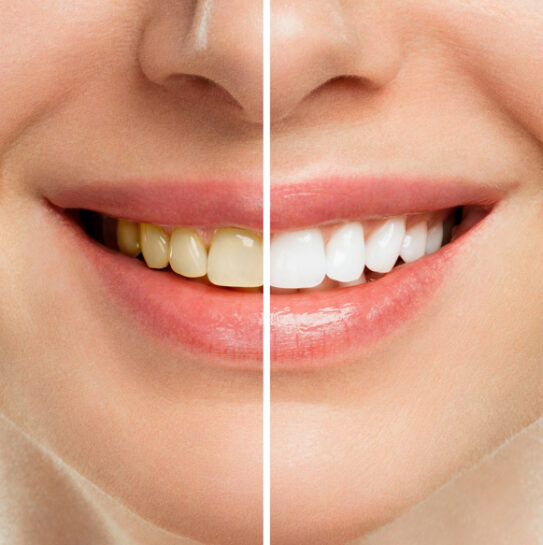 Teeth Whitening