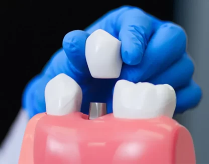 How to Keep Your Dental Implants Clean and Healthy 